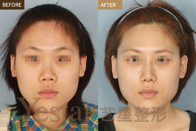 做假体隆鼻手术需要多久？