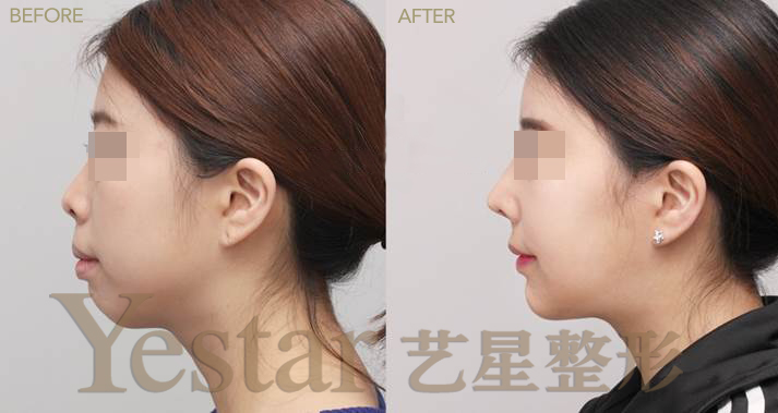 成都隆鼻大概要多少钱？