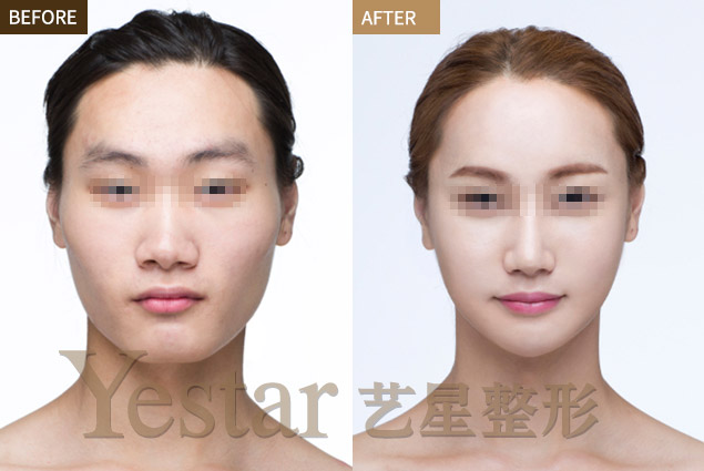 成都打瘦脸多少钱