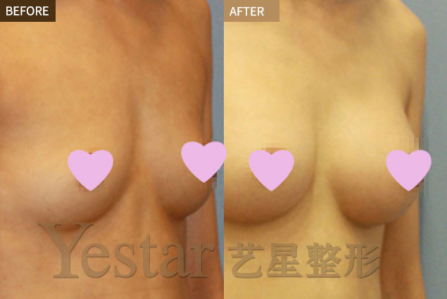 妙桃假体有几种类型