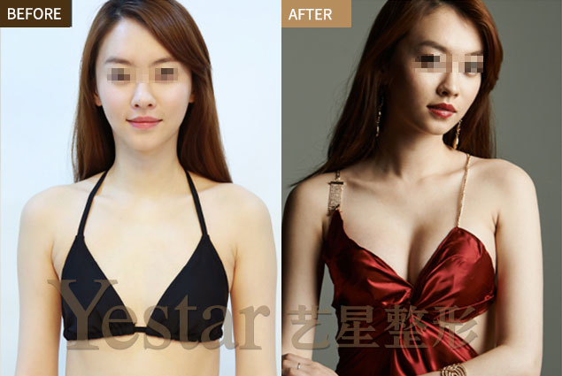 新麦格和妙桃假体隆胸哪个好