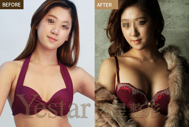 成都哪里有做妙桃假体隆胸的